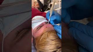 Watch A Forehead Mole Being Removed in 30 seconds [upl. by Rendrag]