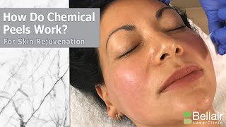 How do chemical peels work for skin rejuvenation [upl. by Haggar]