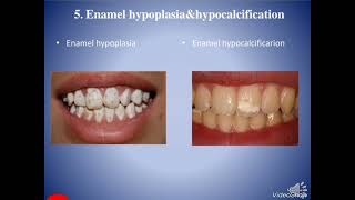 الفرق بين Enamel hypoplasia and enamel hypocalcification [upl. by Lrigybab97]