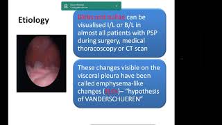 Pneumothorax Dr Kamran Ali India [upl. by Estele]