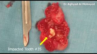 Dr Aghyad  Dentigerous cyst of mandible  excisional biopsy [upl. by Nagiem]