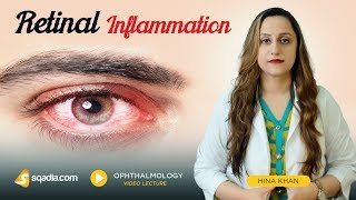 Retinal Inflammation  Clinical Ophthalmology Video  VLearning  sqadiacom [upl. by Alpheus]