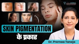 Skin Pigmentation के प्रकार  Clinic Eximus [upl. by Anyar]