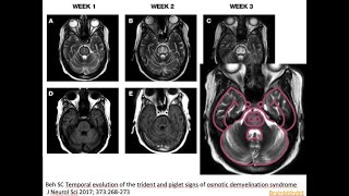 45 Osmotic demyelination syndrome ODS pontine myelinolysis hyponatriemia correction piglet sign [upl. by Eikcuhc]