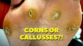 THICK DEEP Seeded Corn and Callus Removal [upl. by Aikram]