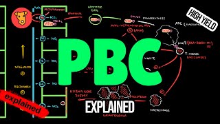 PRIMARY BILIARY CHOLANGITIS Pathogenesis Symptoms Diagnostic criteria PBC Treatment CIRRHOSIS [upl. by Attennaej733]