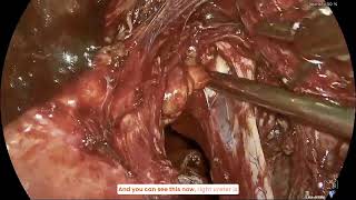 TLH  BSO  Adhesiolysis  Ureterolysis sos laparotomy [upl. by Bonita693]