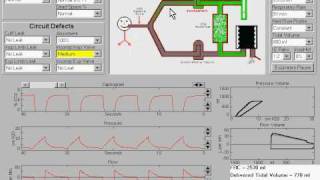 Incompetent Inspiratory Valve in Anesthesia Machine [upl. by Valentino]