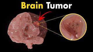 Brain tumors Gliomas  Symptoms Diagnosis amp Treatments [upl. by Trini]