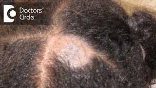 What causes Scalp Ringworm Effective Treatment   Tinea Capitis  Dr Tina Ramachander [upl. by Odnanreh957]