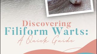 Discovering Filiform Warts A Quick Guide [upl. by Naujd]