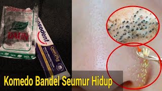 Solusi Handal Menghilangkan komedo bandel seumur hidup [upl. by Orvil609]