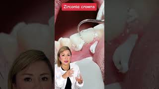 ¡Renovando sonrisas con coronas de zirconio 🦷💎 [upl. by Arema119]