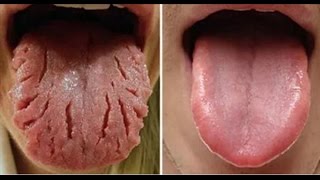 These 9 Changes on Your Tongue Reveal Almost All Your Diseases [upl. by Betsey]