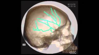 quotStarchild Skull NOT Hydrocephalusquot  Dr Robinson [upl. by Stein]