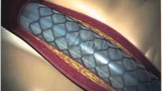 Angioplastia con Stent Parte 22  FOSCAL [upl. by Lashondra]