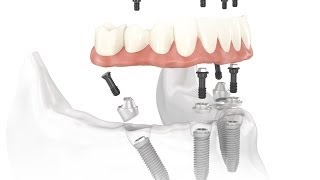 Dental Implant Osseointegration Process [upl. by Worthington]