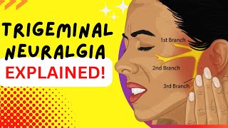 Trigeminal Neuralgia  Explained  Worlds most painful disease Causes and Treatment [upl. by Dolphin945]