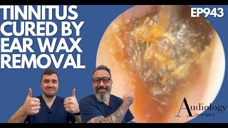 TINNITUS CURED BY EAR WAX REMOVAL  EP943 [upl. by Drisko]