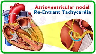 Atrioventricular nodal reentrant tachycardia AVNRT  USMLE [upl. by Diarmit2]