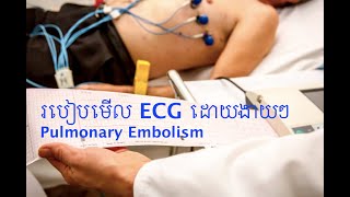 83 EKG case pulmonary embolism [upl. by Klute]