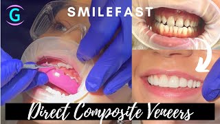 Composite Veneers For Gaps  TASHAS SMILEFAST TRANSFORMATION [upl. by Strait385]