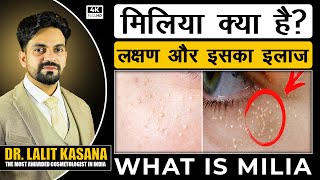 WHAT IS MILIA  मिलिया क्या है लक्षण और इसका इलाज DR LALIT KASANA [upl. by Enelrad]