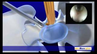 maxMorespine endoscopic animation [upl. by Vicki]