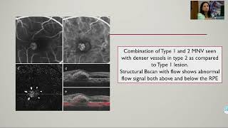 KSOS2022 3 Understanding Choroidal Neovascularisation Dr Manoj S [upl. by Motch467]