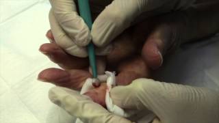 How to remove a Pyogenic Granuloma using surgery [upl. by Milena]