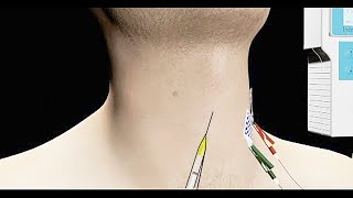 Spasmodic Dysphonia Treated with EMG Guided Botox Injection [upl. by Nolyad]