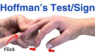 How to Perform a Hoffmans Test  Inverted Supinator Sign  Clonus  Hyperreflexia [upl. by Gilroy]