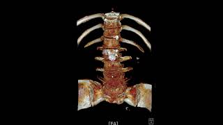 L45 spondylolytic spondylolisthesis [upl. by Langan]