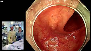 Characterization and resection of a recurrence of a SSL sessile serrated lesion in the colon [upl. by Humo]