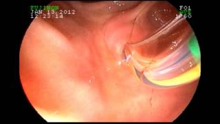 Biliary Manometry  Sphincter of Oddi [upl. by Stanway50]