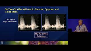 Severe Aortic Stenosis [upl. by Maffa693]