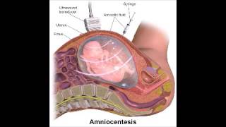 Amniocentèse  Dictionnaire français audio [upl. by Erdna]