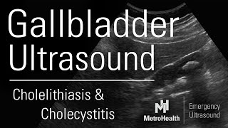 Gallbladder Ultrasound [upl. by Nylla]