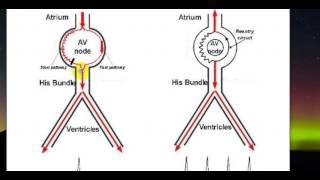 1  Cơ chế cơn AVNRT [upl. by Nerte294]