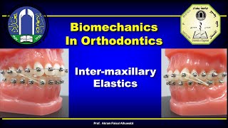 Intermaxillary Elastics in Orthodontics [upl. by Noevart]