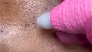 DPN Dermatosis Papulosa Nigra Removal [upl. by Ainslee230]