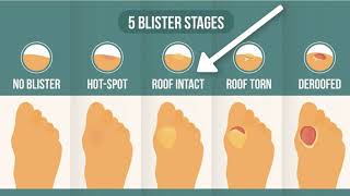 How To Treat A Blister Correctly First Look At Your Blister Roof [upl. by Elocn]