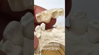 Veneer and Bridge👍😃 indradentalvlogs veneers dentist shorts drrahultripathi [upl. by Shanan]