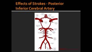 Effects of Strokes  Posterior Inferior Cerebral Artery [upl. by Assirialc116]