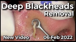 Deep Blackhead Removal by drkasanas [upl. by Illehs]