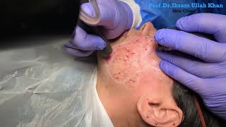 Unbelievable Skin Transformation with Erbium YAG Laser Acne Scar Treatment lasertreatment acne [upl. by Bander]