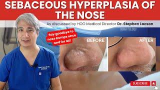 DERMATOLOGIST EXPLAINS HOW TO TREAT NOSE BUMPS DUE TO SEBACEOUS HYPERPLASIA [upl. by Tama]