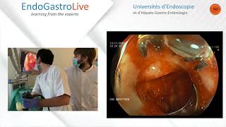 Hemostase endoscopique dun ulcère duodénal hémorragique [upl. by Venetis]