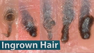 Ingrown Hair Removal Close up 200X  埋没毛を除去 [upl. by Nitaj]