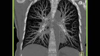 Lung Anatomy Normal Lung Vasculature [upl. by Kyre]